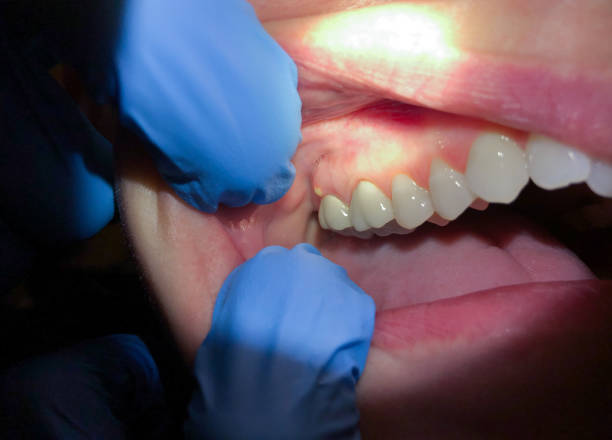 Best Emergency Denture Repair in Pocasset, MA