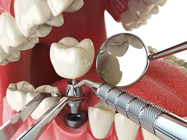Best Broken or Chipped Tooth Repair in Pocasset, MA
