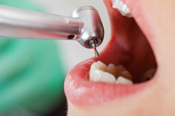Best Emergency Wisdom Tooth Extraction in Pocasset, MA